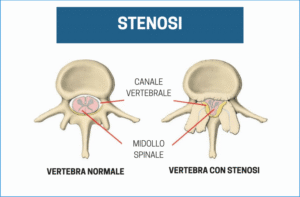 Stenosi del Canale Vertebrale
