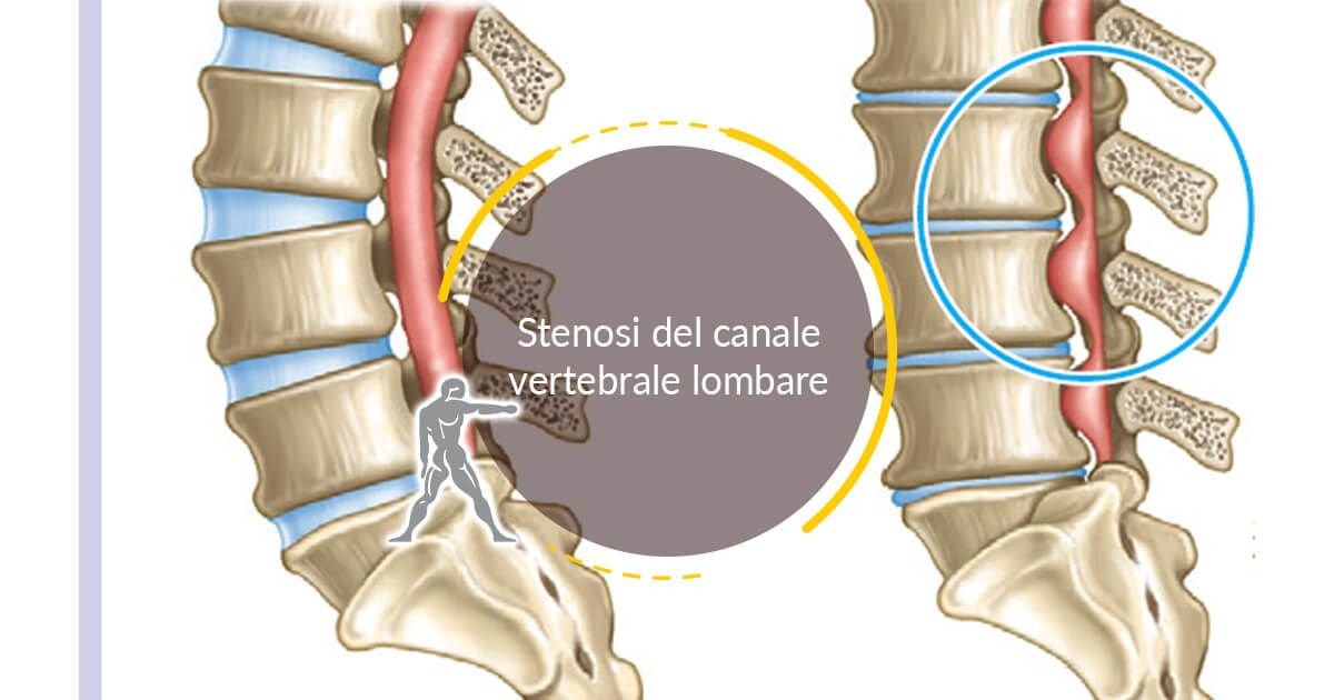 instabilità vertebrale lombare degenerativa o traumatica
