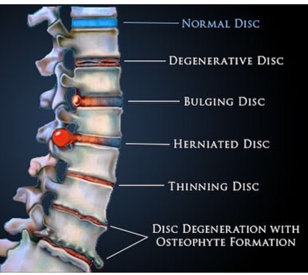 Discopatie Degenerative