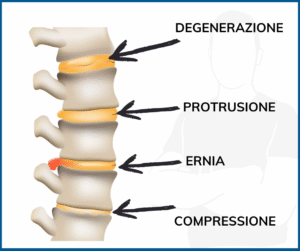 Protrusione cervicale (discopatia) C5-C6 o C6-C7